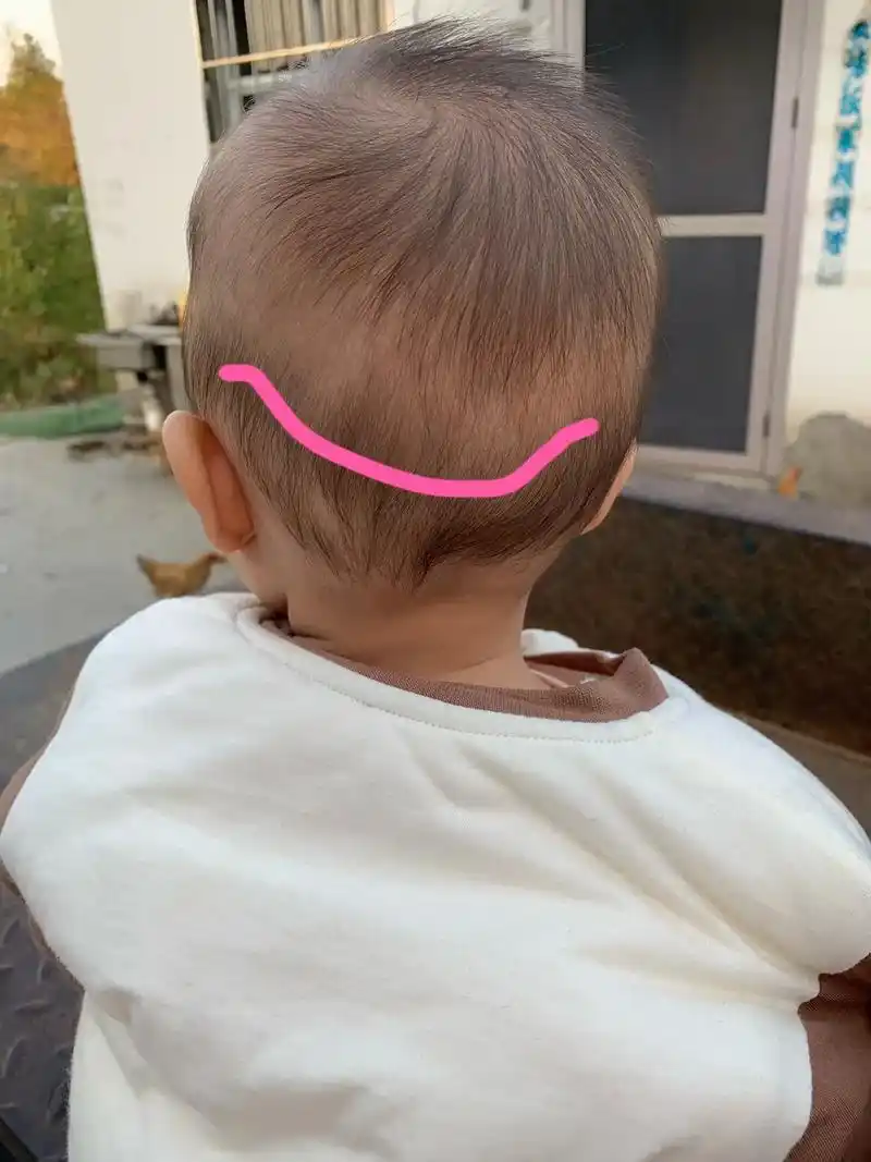 你们的宝宝头上也有这一圈吗?还是什么,听说是钙圈,缺钙的现象 - 抖音