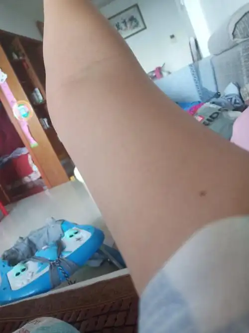 女人右手臂内侧是什么痣