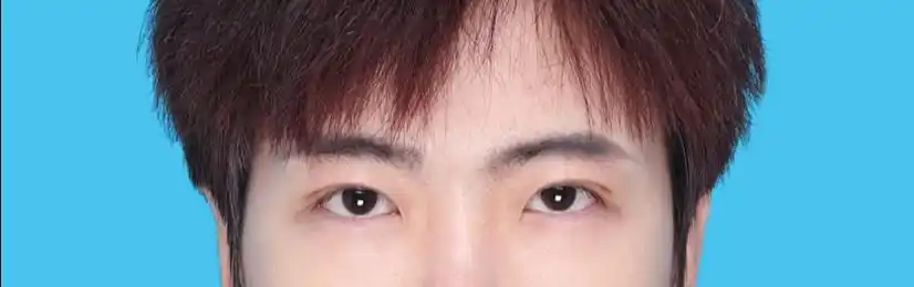 三个月反馈男生平扇双眼皮南京胡亮