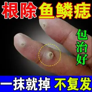 鱼鳞痣药膏专用药去猴子肉粒疙瘩血胞刺手部长扁平寻常拓疣去除膏