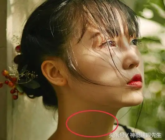 脖子上的痣能不能点脖子上有三颗痣不能点掉