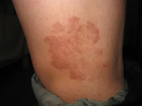 看图识病------体癣 - 皮肤及性传播疾病讨论版 - 爱爱医医学论坛