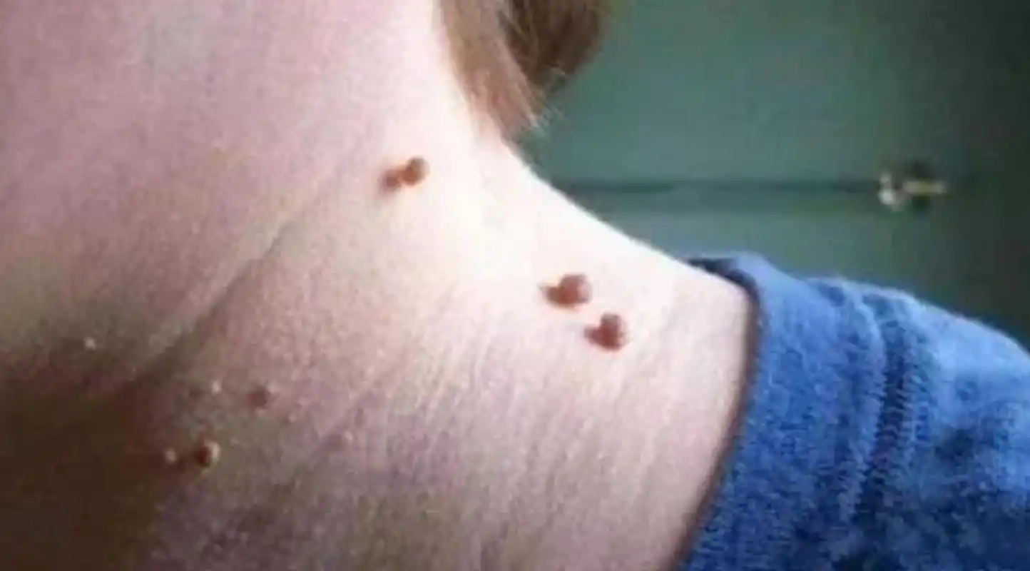 见图,这种疣叫丝状疣,是感染低危型hpv引起的,生活中有很多人用手抠