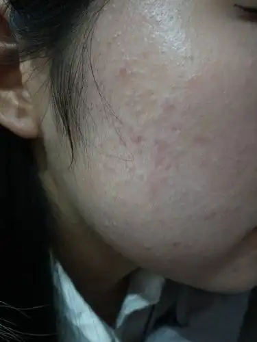 脸上长了好多痘痘,有医生说是毛囊炎,也有说是青春痘,试了n多办法