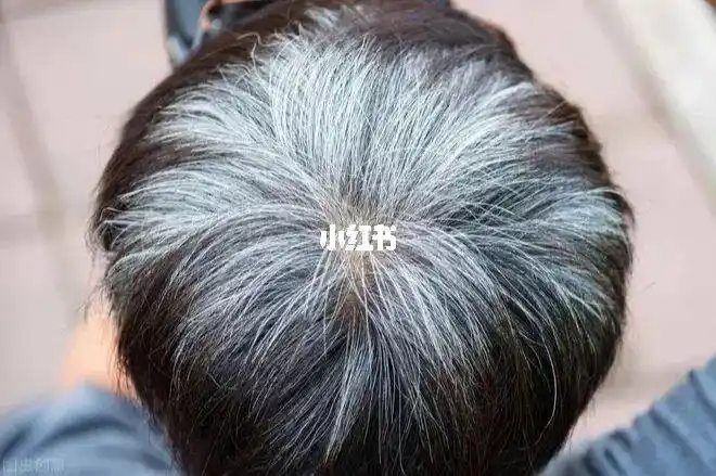 人在压力下,头发变白的人