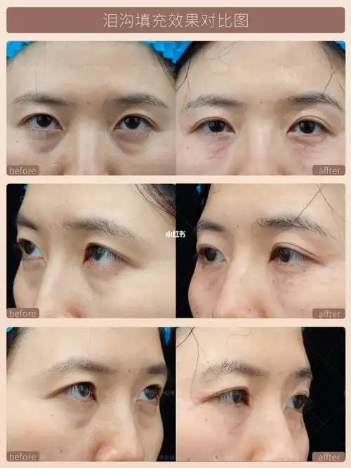 嗨体熊猫针即可效果_嗨体_熊猫_泪沟神器_泪沟_黑眼圈_美食_美食探店