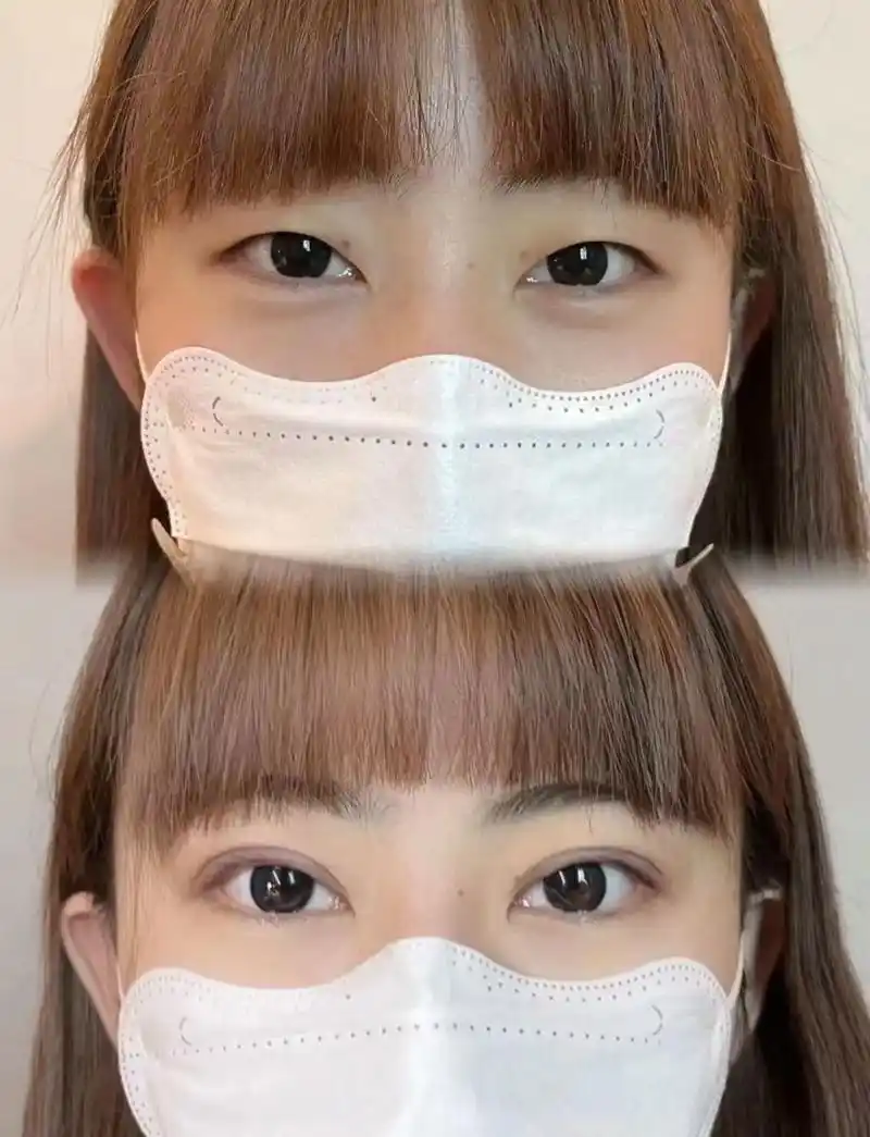 埋线双眼皮恢复两个月过程#美学设计 #纳米无痕双眼皮 - 抖音