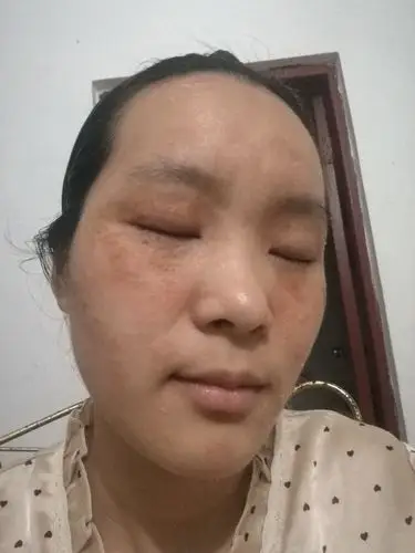 过敏性皮炎,裸脸第二天