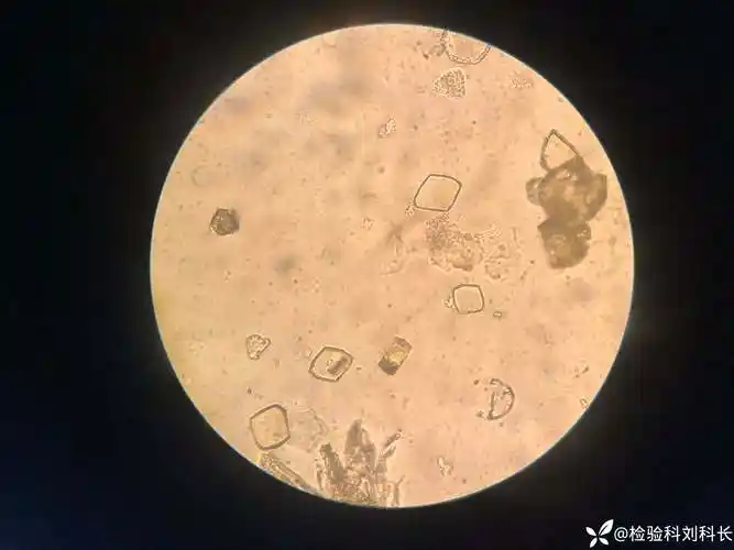 尿液有形成分之尿酸结晶