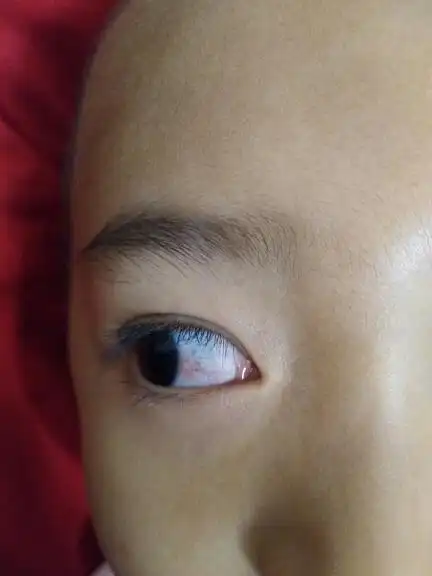 小孩6岁,眼角红了2天,滴滴眼药水后就变成现在这样