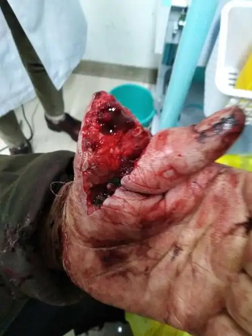 大母趾的伤口图片发自app