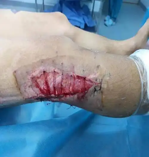 医院故事工地受伤险截肢9个诊断多次手术保腿成功