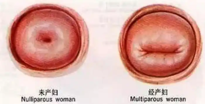 女人下面松弛什么症状如何判断是否阴道松弛