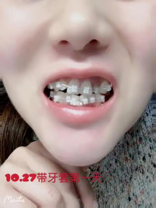 了),上4号牙因为和虎牙重叠一点拔的时候碰到虎牙神经了疼了一个星期