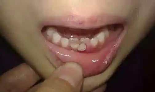 孩子长出"双排牙",竟是因吃得太精细-爱问医生-小队长-爱问医生