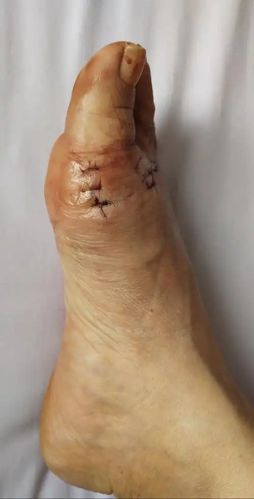 大脚骨,踇外翻畸形 - 好大夫在线