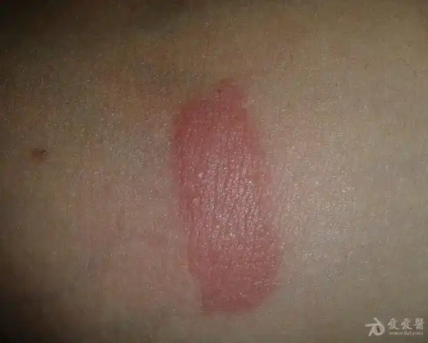 看图识病---------------接触性皮炎 - 皮肤及性传播疾病讨论版