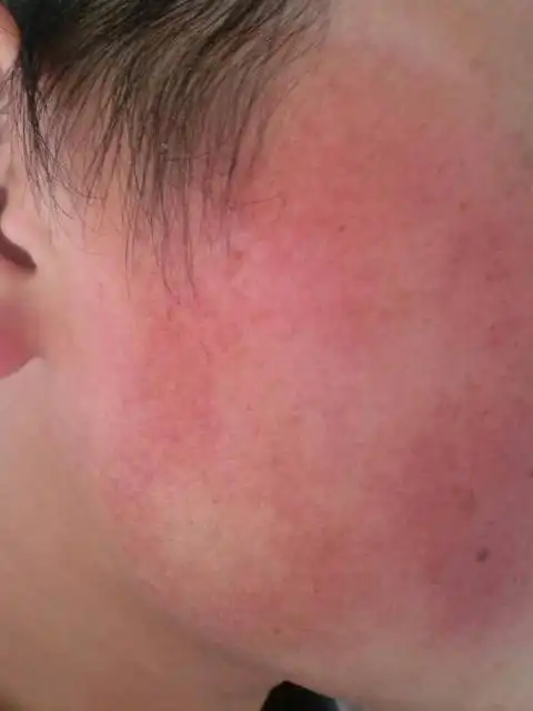 为什么宝宝肌肤会过敏宝宝皮肤为什么会过敏