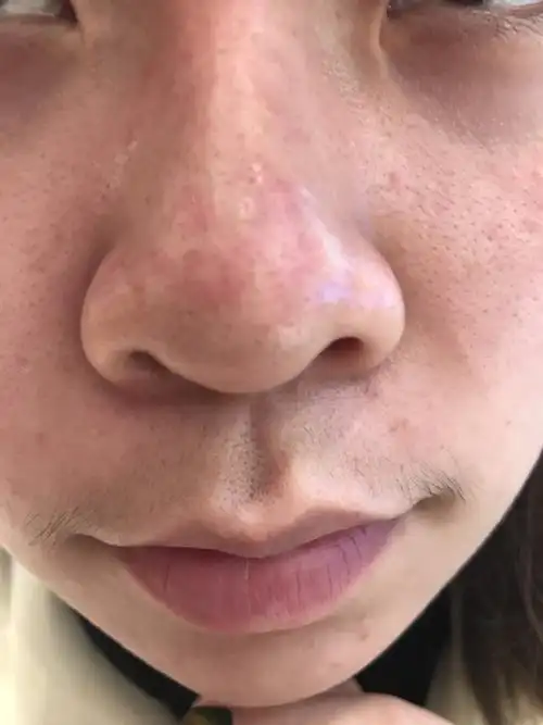 毛孔粗大怎么办