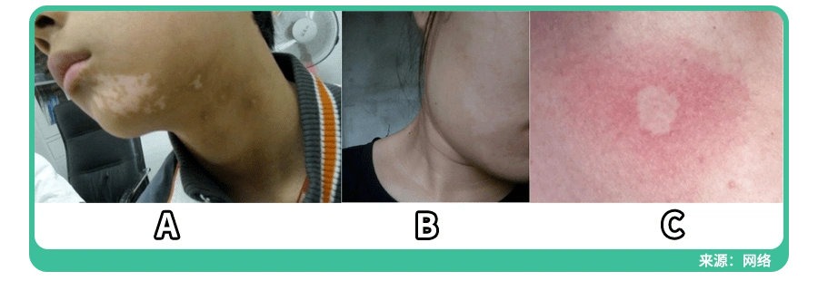 同样是白斑,白色糠疹和白癜风如何区分?_皮肤_孩子_图片