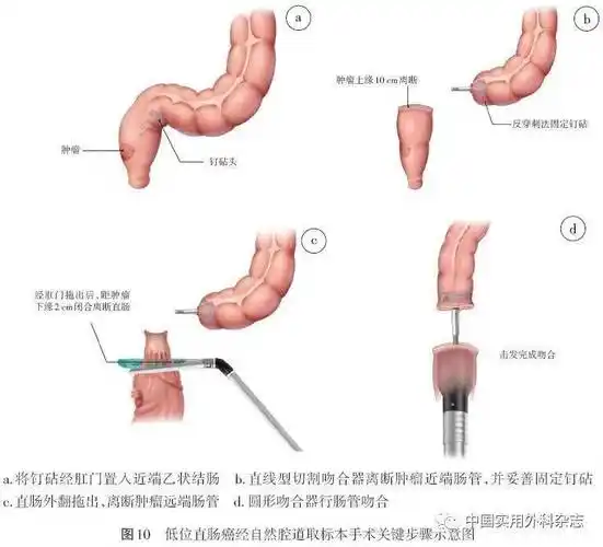 中低位直肠癌手术消化道重建中国专家共识(2021版)