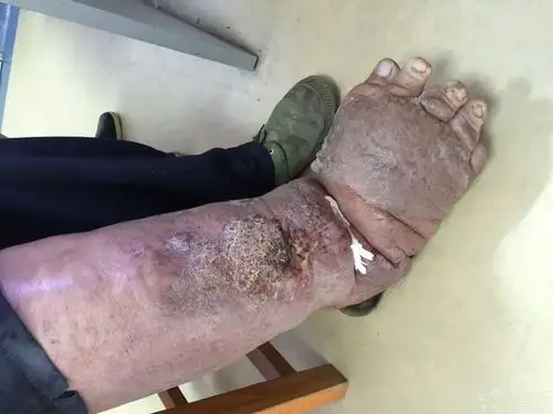 门诊惊现"象足腿":需要截肢吗? [病例帖]