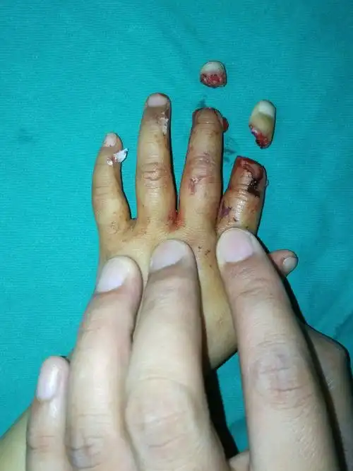 一岁多幼儿两手指头被皮带完全绞断再植成活