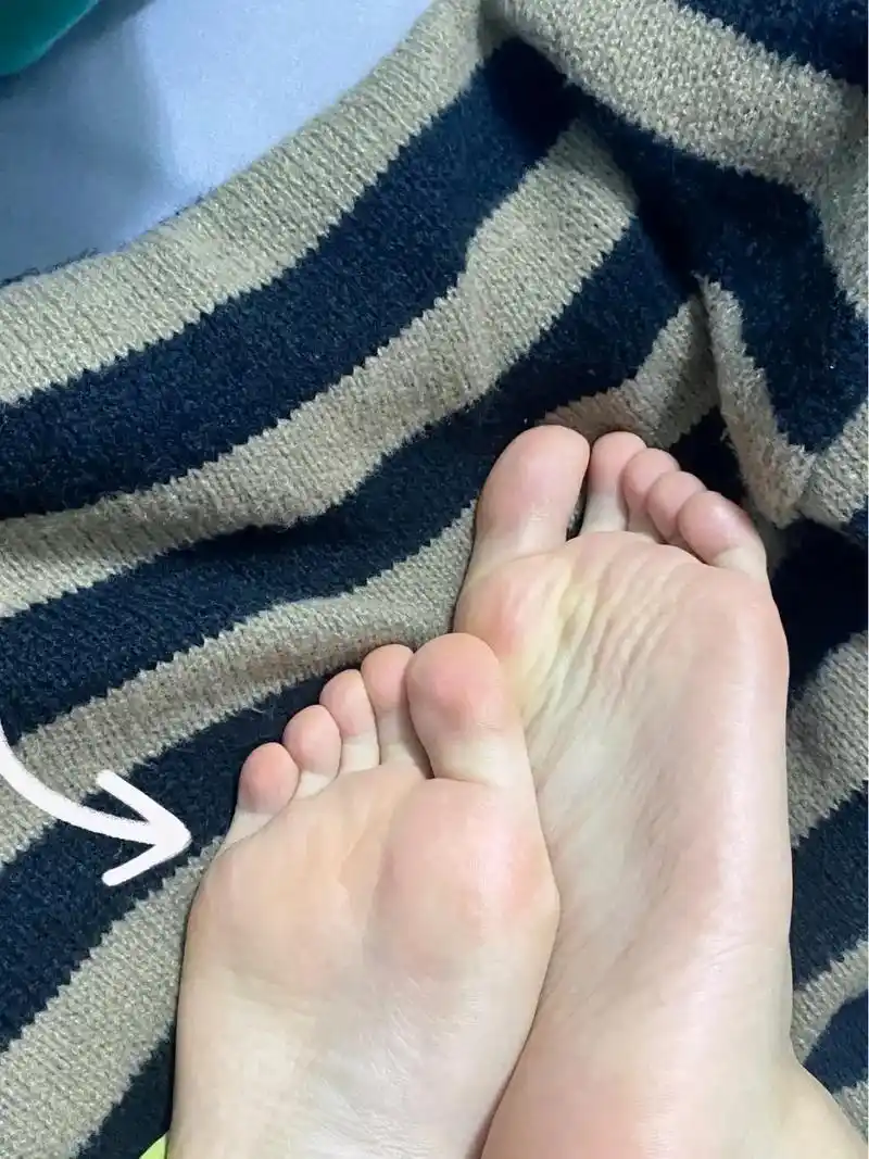脚底板真的没茧子了!自己脚上茧子太厚了真的给我造成 - 抖音