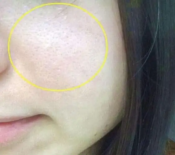 主要原因有三点一,毛孔堵塞:年轻人的皮肤,往往皮脂腺分泌较为旺盛