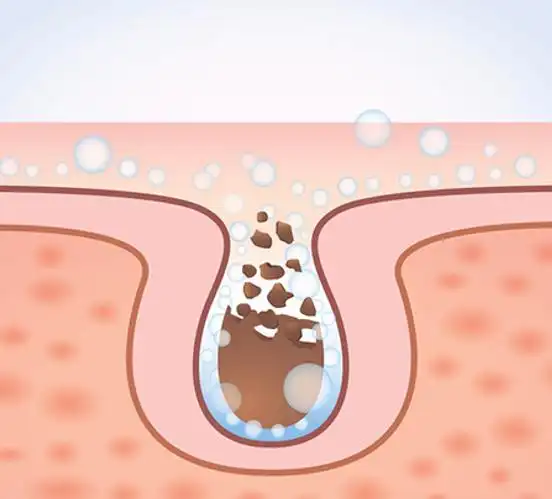 这是一篇来自蕾特恩分享关于毛孔粗大的解惑科普