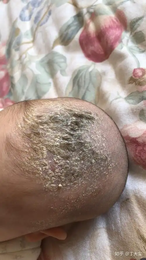 见过的最大头皮屑多大? - 知乎