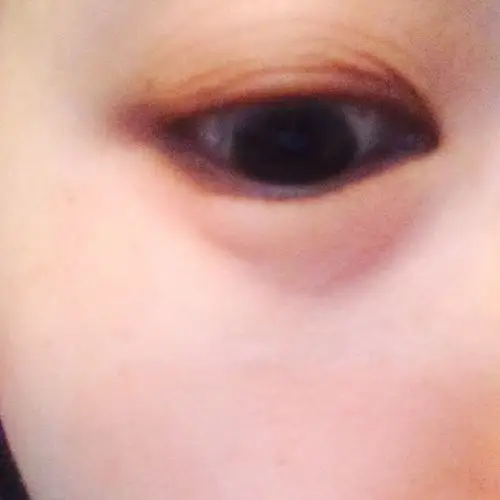 眼睛眼袋位置突然长个大水泡怎么回事就是这样的,我没眼袋只是黑眼圈