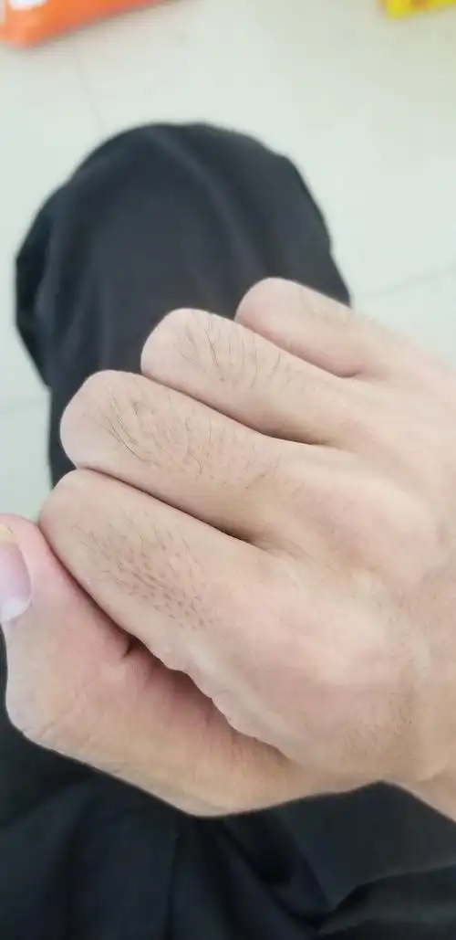 手指上长毛是一种什么样的体验? - 知乎