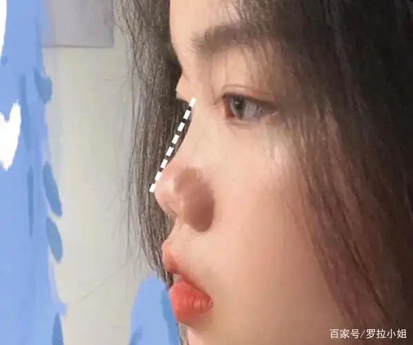 图片来源小红书用户@stella 通常,鼻梁塌的鼻子,山根也是塌的.