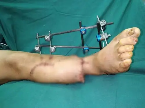 术后这是一场与时间,与生命赛跑的手术,这次断肢再植手术成功标志着大