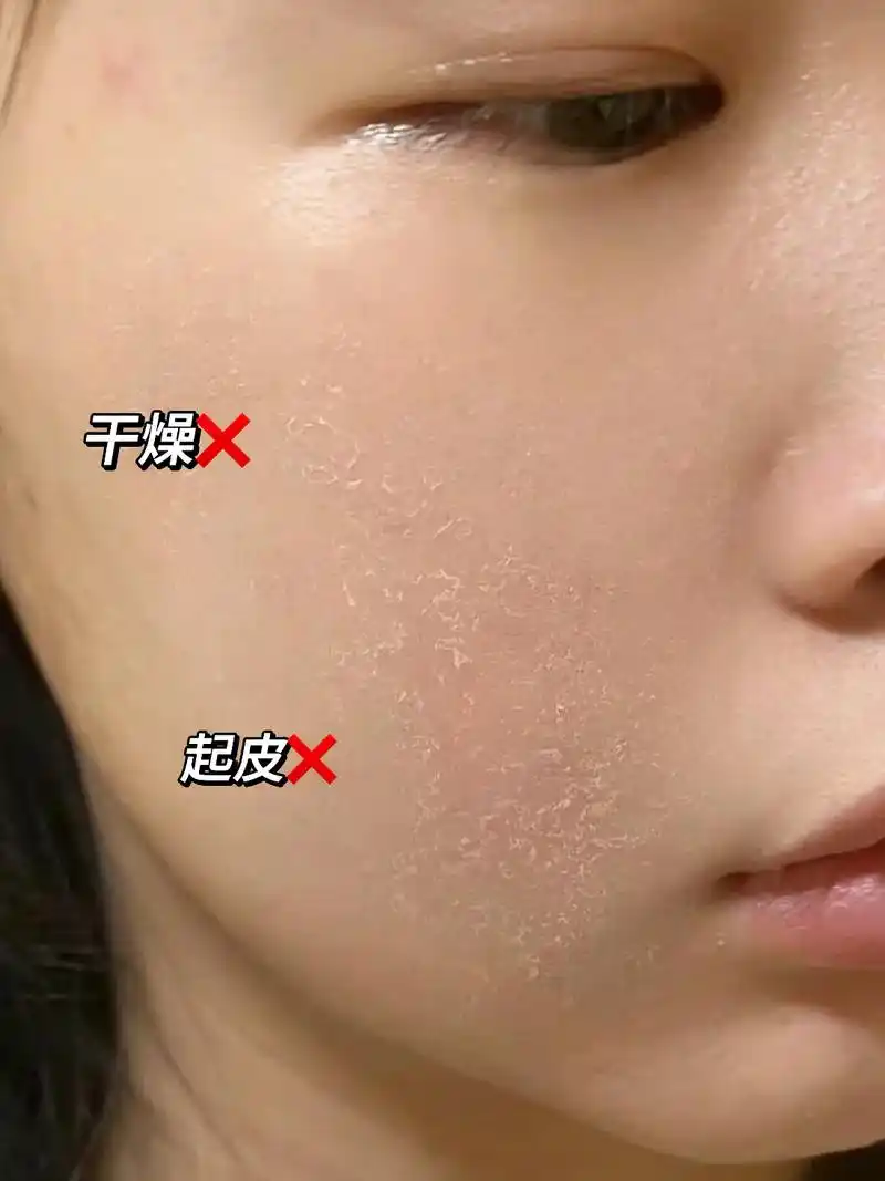 脸上起皮皮!皮肤干燥又粗糙!显得老!还在为冬季皮肤状态差烦 - 抖音