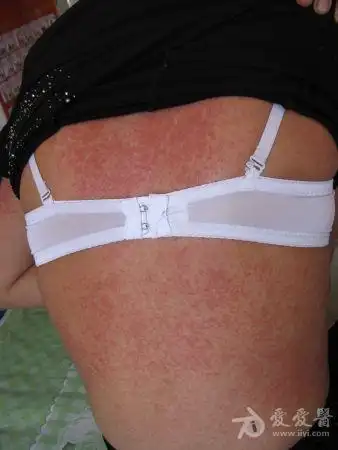 皮肤红疹伴发热 - 皮肤及性传播疾病讨论版 - 爱爱医医学论坛 - 爱爱