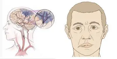 引起面神经麻痹的5大常见原因