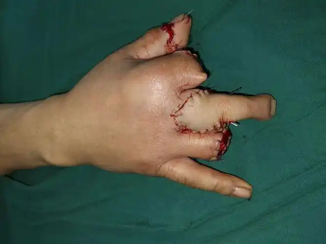 数字化设计,3d打印辅助手指再造,我们是认真的!