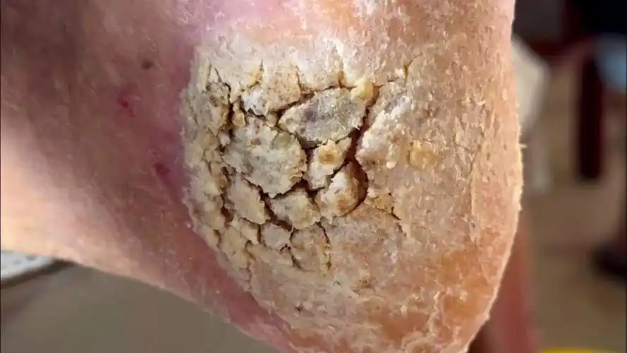 脚底开裂,厚厚的污垢和死皮