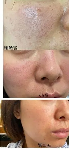 毛孔粗大做医美多少钱_毛孔粗大做医美多少钱一次