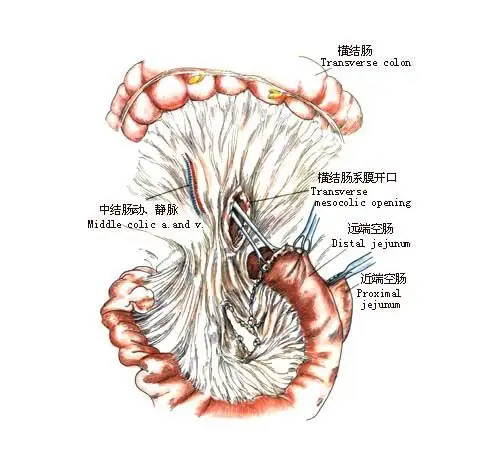空肠食管roux-en-y吻合术-手术图解