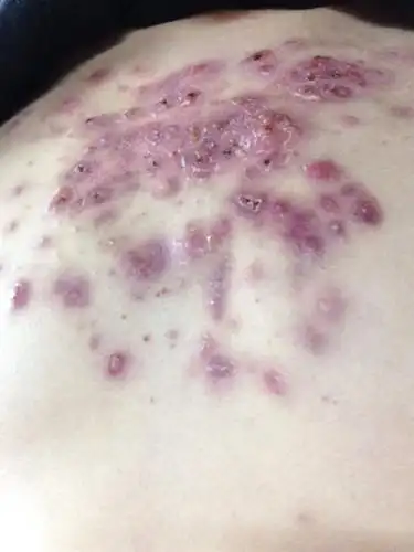 也去医院看了 说是体内毒素发出来的 排排毒就好  可他还是担心是皮肤