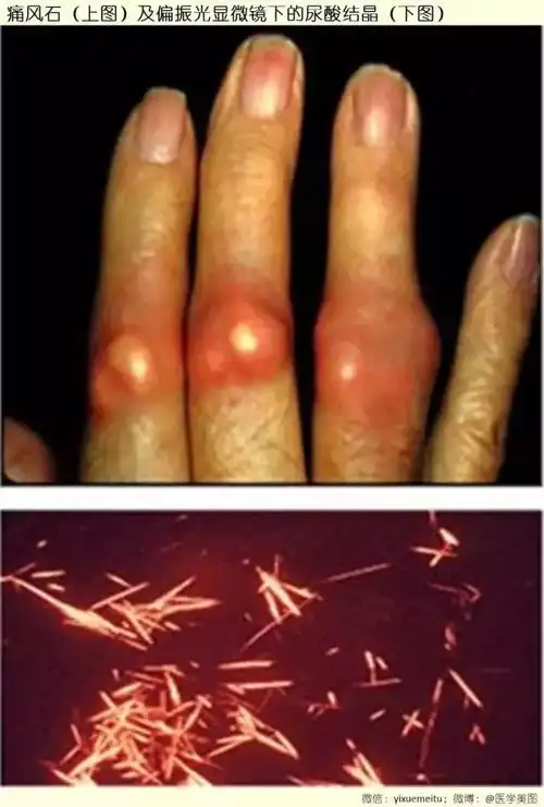 风湿图谱痛风石及偏振光显微镜下的尿酸结晶
