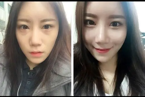 自体脂肪填充苹果肌效果图分享肌肤q弹的秘诀