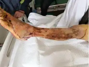 争分夺秒的200公里只为保住被宣判截肢的腿