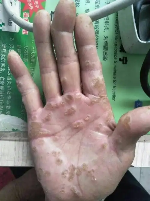 点状掌跖角化病