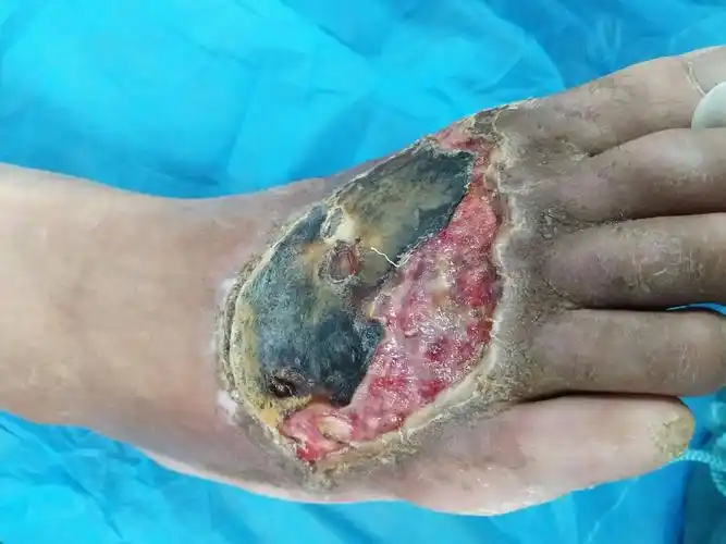 外二科救治一例创面坏死有感