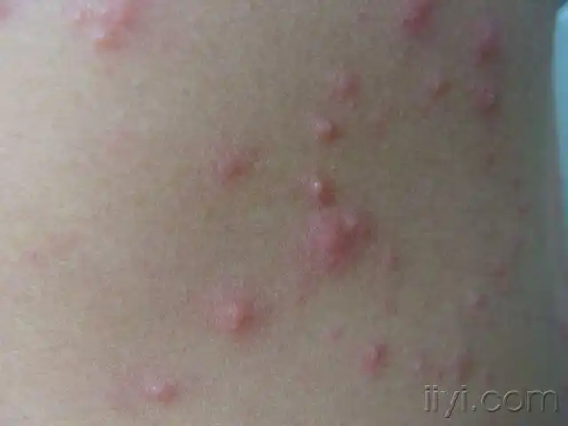 看看是什么病周身红斑丘疱疹