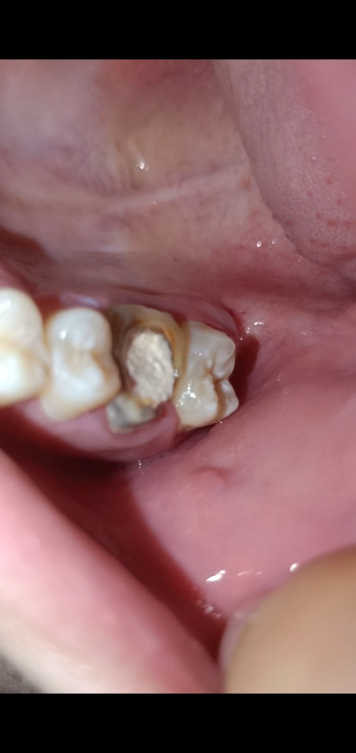 右上内第二颗大牙小时候可能吃糖吃多了有蛀牙没管它后来